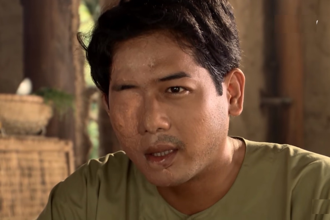 Khuôn mặt sẹo của Đức Nhã tron